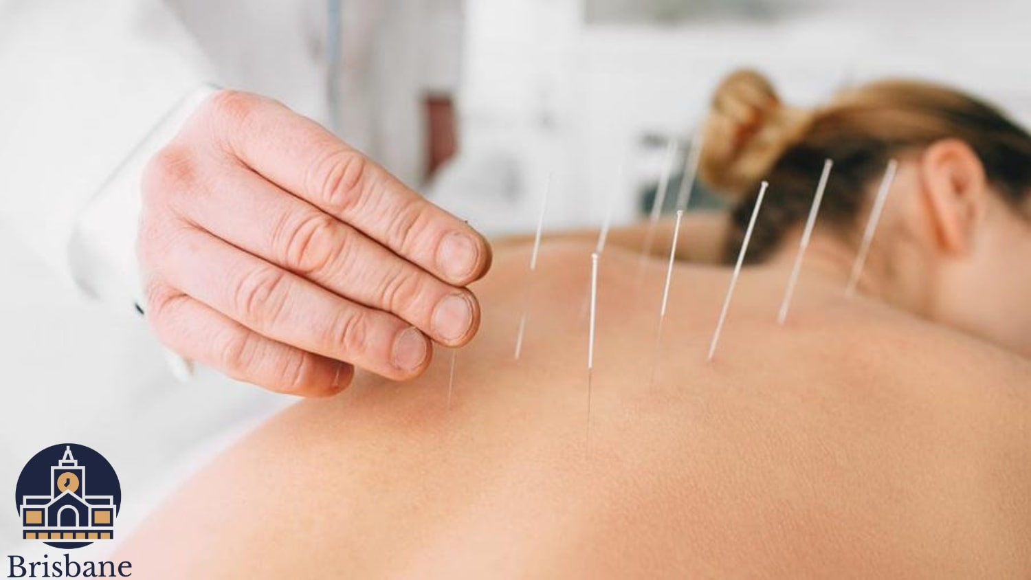 The 5 Best Acupuncture Services in Brisbane's Homepage